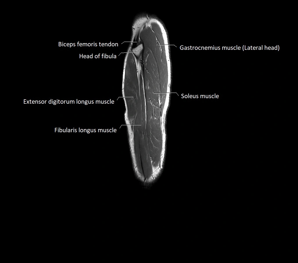 Lower leg sagittal anatomy 3T MRI image 6.webp